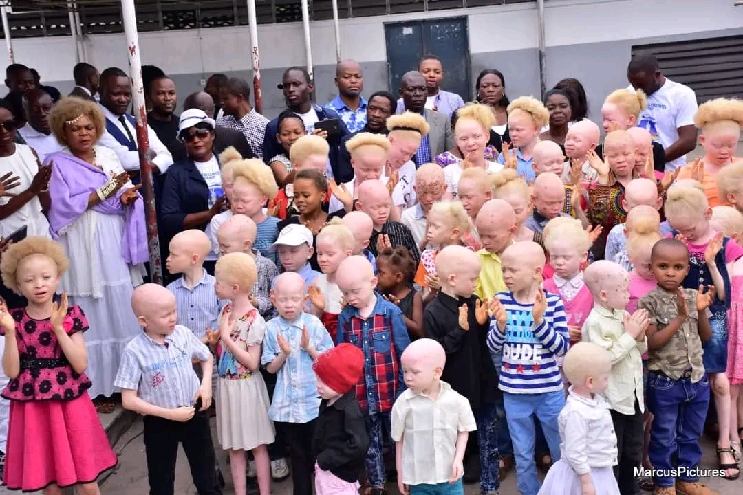 Integrated program of dermatological care, psychosocial support, i of people with albinism.